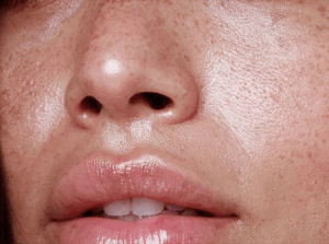 Sensitive skin