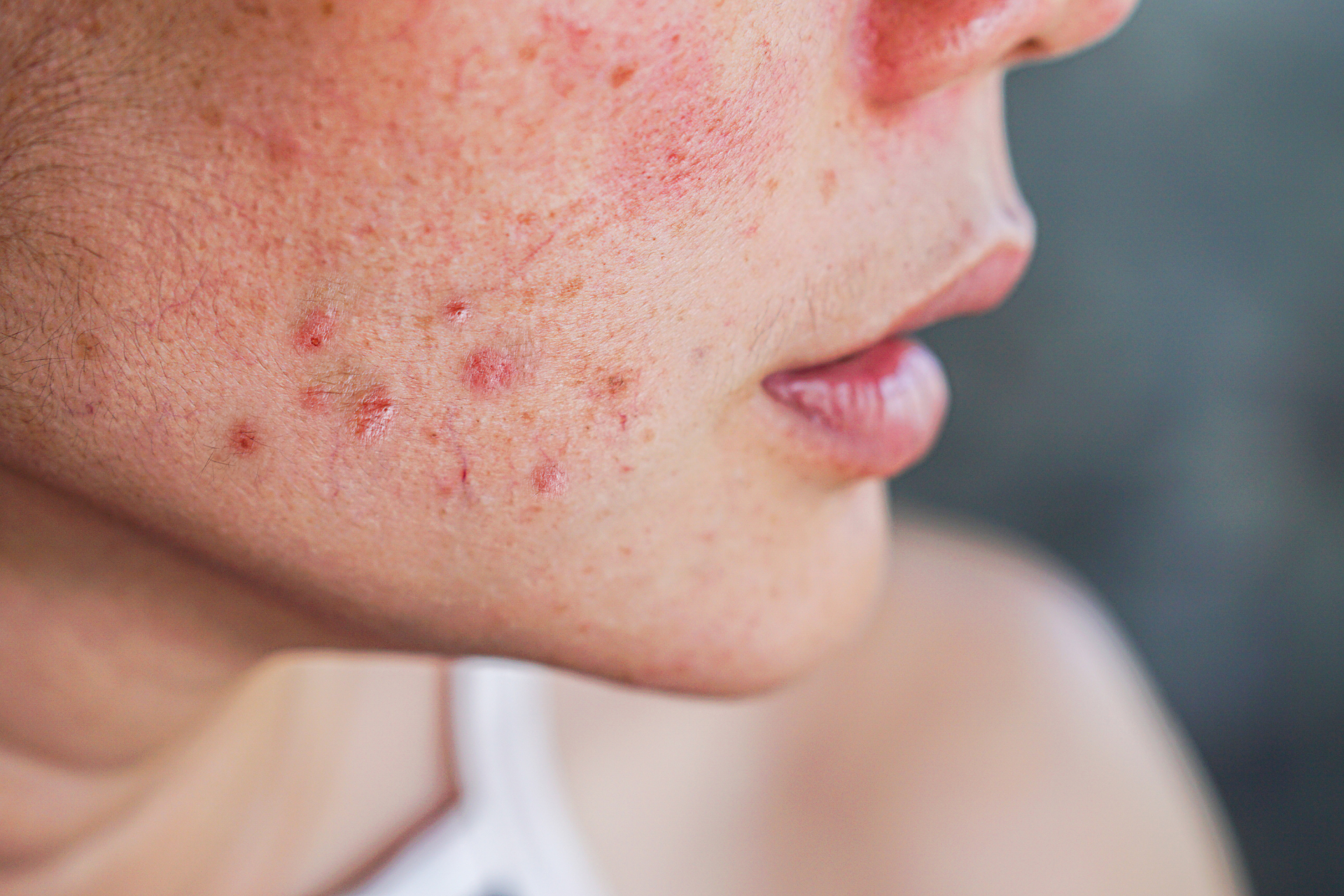 Vor und nach der Retinol-Anwendung: Welche Veränderungen treten in Ihrer Haut auf? 1 https://aptmedicalaesthetics.com/wp-content/uploads/2023/08/image2.png
