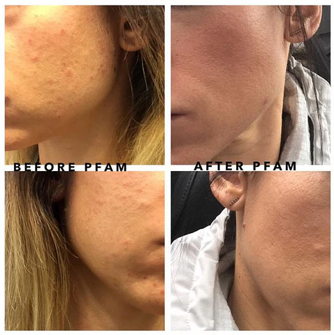 Vor und nach der Retinol-Anwendung: Welche Veränderungen treten in Ihrer Haut auf? 6 https://cdn.shopify.com/s/files/1/1624/2309/files/PFAM-Retinol-Before-After_large.PNG?v=1572237359